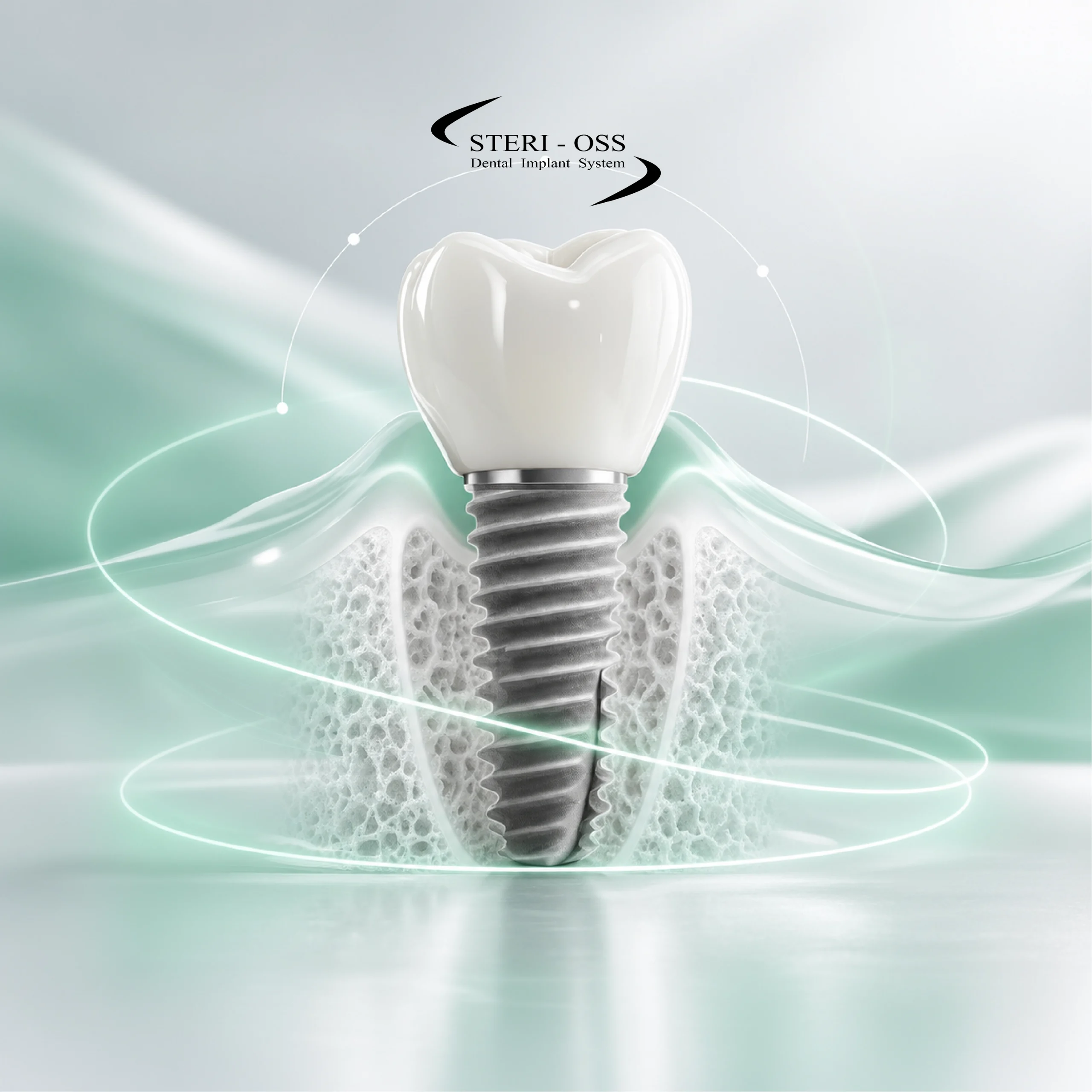 Fresh Socket و Immediate Implant Placement