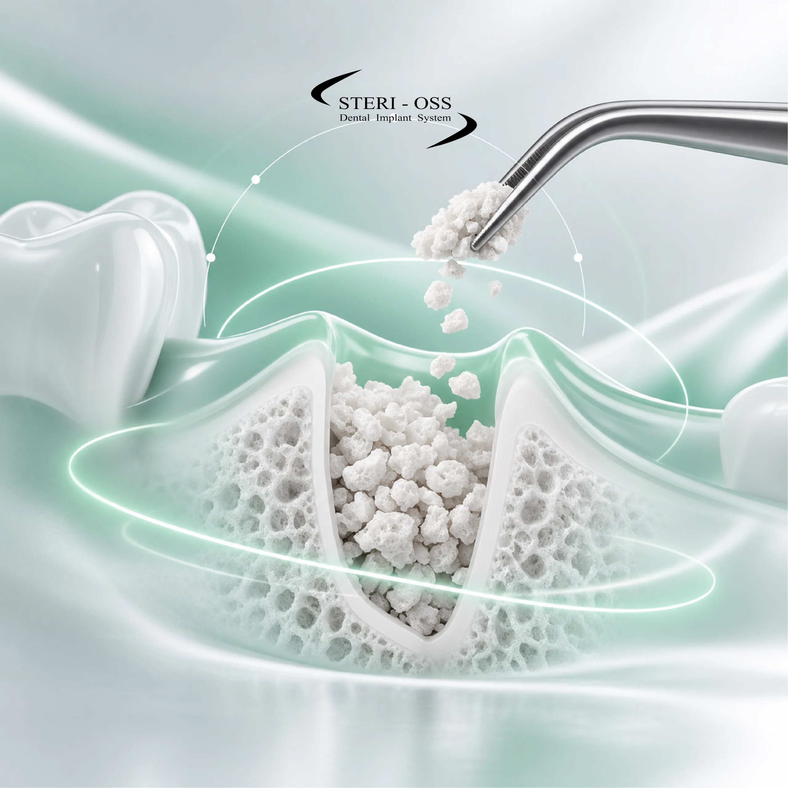 تکنیک‌های Atraumatic Extraction و حفظ Socket در Immediate Implant Placement