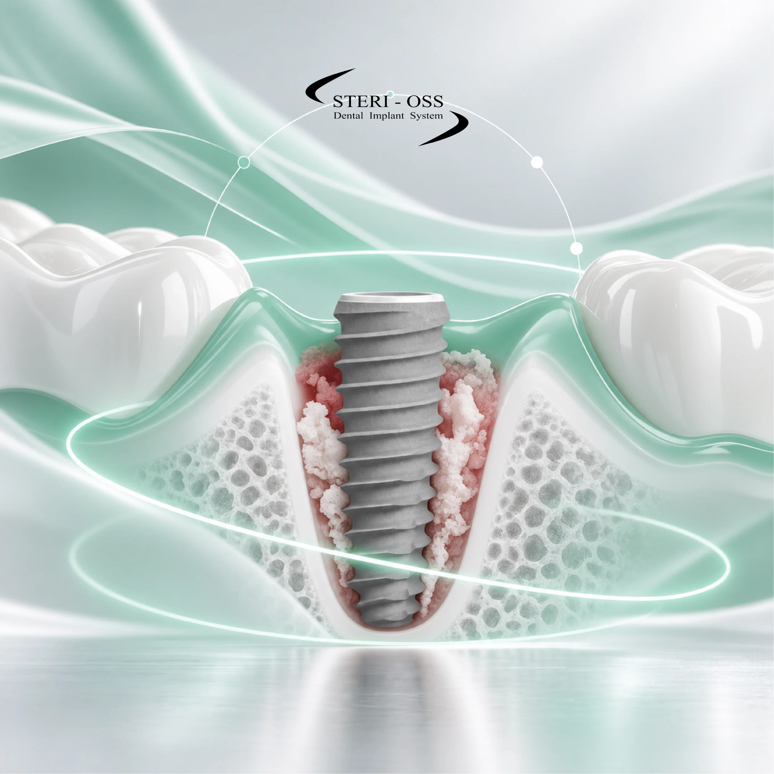 نحوه صحیح قرارگیری ایمپلنت در Fresh Socket اصول Positioning سه‌بعدی، انتخاب ابعاد ایمپلنت و مدیریت Jumping Gap